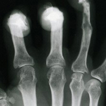 xray of arthritis in hand